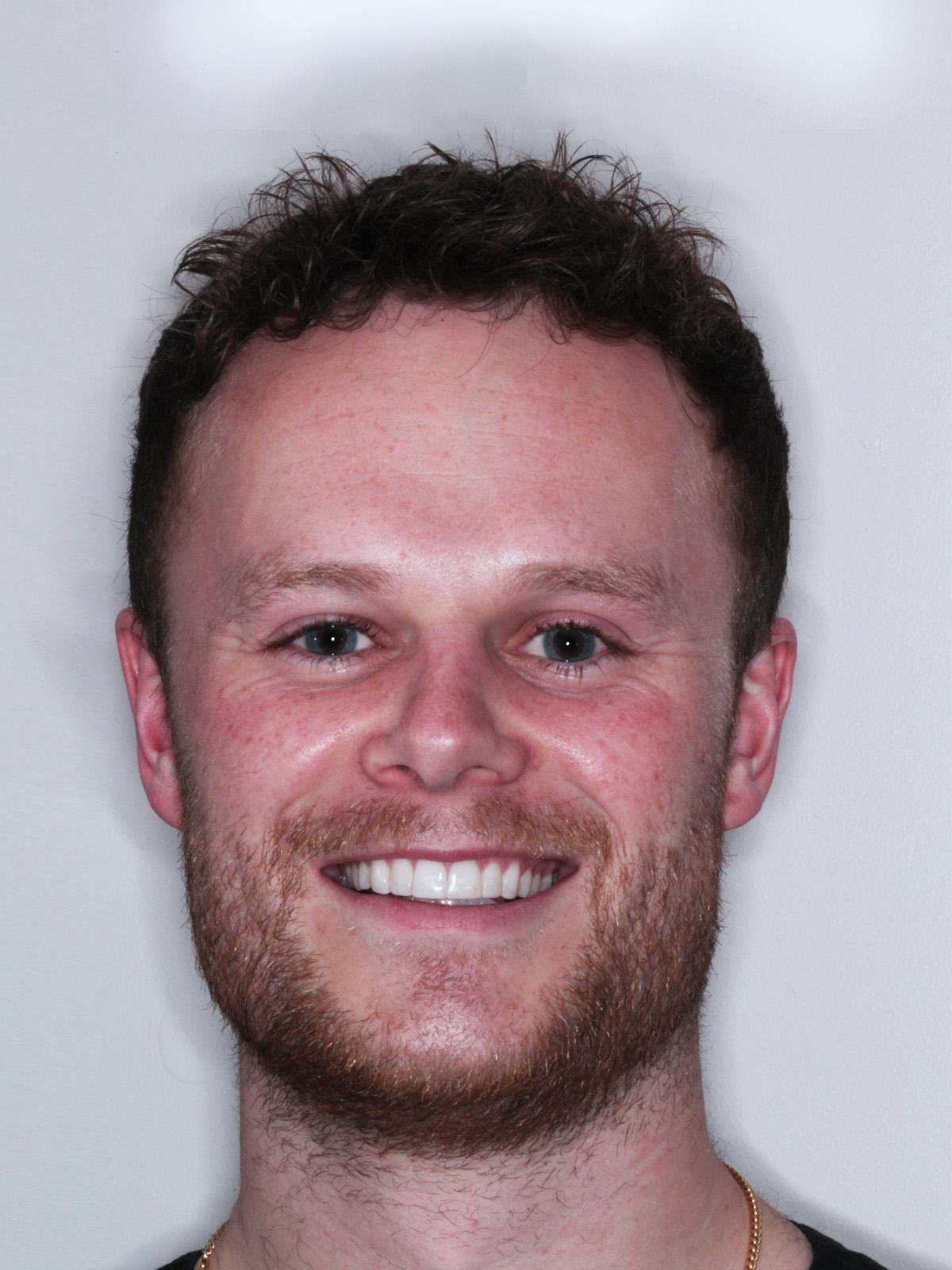 Max-New Invisalign Braces Solihull